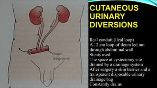 CUTANEOUS
URINARY
DIVERSIONS
Ileal conduit (ileal loop)
A 12 cm loop of ileum led out
through abdominal wall
Stents used
The space at cystectomy site
drained by a drainage system
After surgery a skin barrier and a
transparent disposable urinary
drainage bag
Constantly drains
 