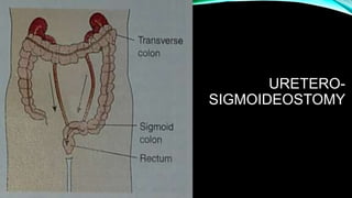 URETERO-
SIGMOIDEOSTOMY
 