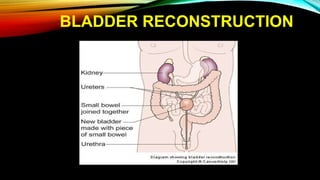 BLADDER RECONSTRUCTION
 