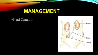 MANAGEMENT
•Ileal Conduit
 