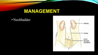 MANAGEMENT
•Neobladder
 