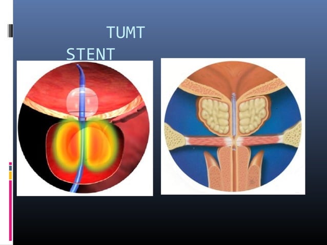 Bladder outlet obstruction | PPT
