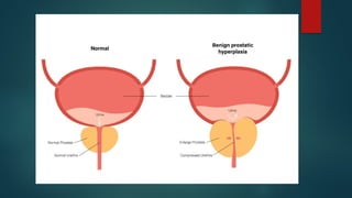 Comprehensive Overview of Symptoms and Signs of Bladder Outlet ...