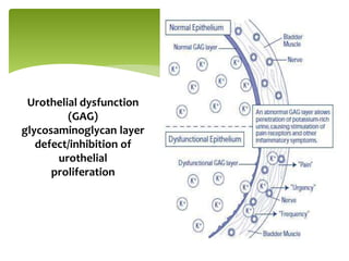 Urothelial dysfunction
(GAG)
glycosaminoglycan layer
defect/inhibition of
urothelial
proliferation
 