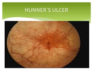 HUNNER`S ULCER
 