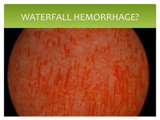 WATERFALL HEMORRHAGE?
 