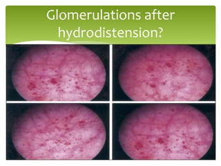 Glomerulations after
hydrodistension?
 