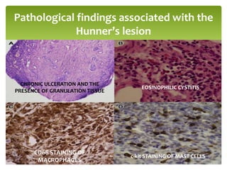 Pathological findings associated with the
Hunner’s lesion
CHRONIC ULCERATION AND THE
PRESENCE OF GRANULATION TISSUE
EOSINOPHILIC CYSTITIS
CD68 STAINING OF
MACROPHAGES
c-kit STAINING OF MAST CELLS
 