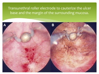 Transurethral roller electrode to cauterize the ulcer
base and the margin of the surrounding mucosa.
 