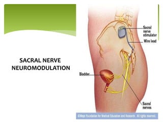 SACRAL NERVE
NEUROMODULATION
 