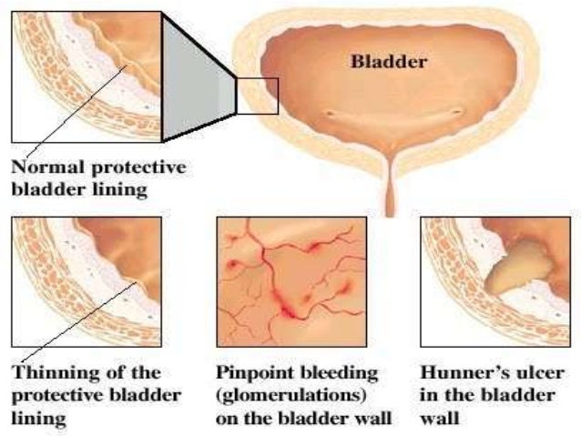 Interstitial Cystitis /Painful Bladder Syndrome – Limmerkoll