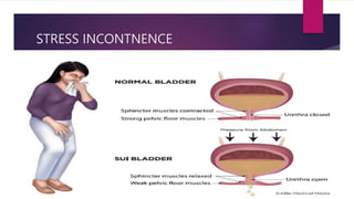 Stress Incontinence Algorithm BLADDER PHYSIOLOGY AND DISORDERS-1.pptx