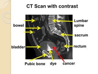 Cancer of the Bladder PPTX