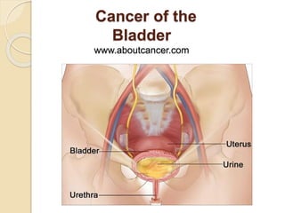 Cancer of the
Bladder
www.aboutcancer.com
 