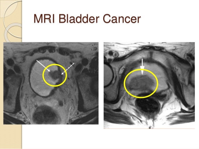 Cancer of the Bladder