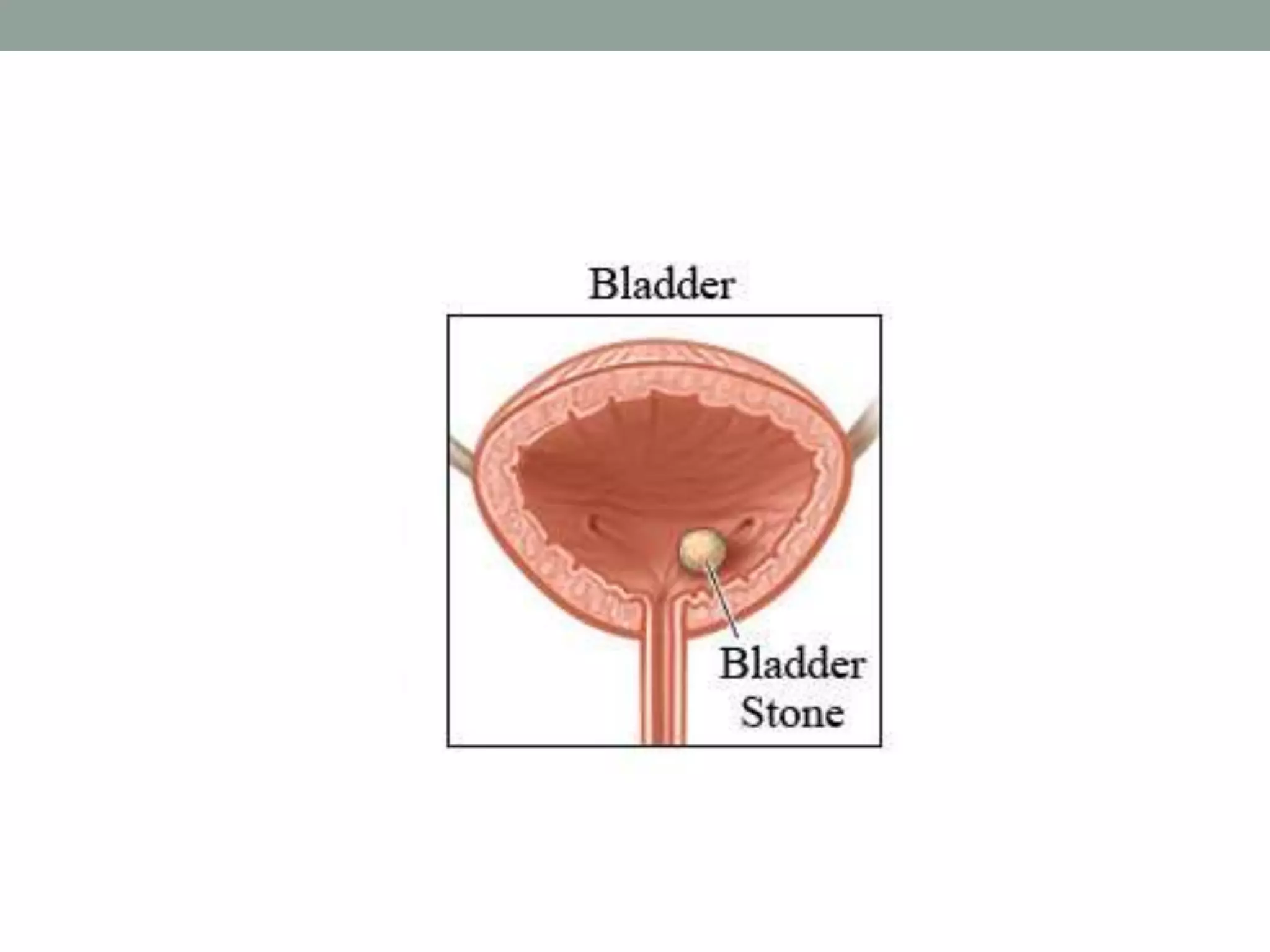 Bladder stones | PPTX