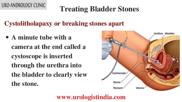bladder stones symptoms bladder treatment in tamil nadu urologist in india bladder stones symptoms bladder treatment in tamil nadu urologist in india