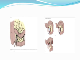 Bladder cancer surgery | PPTX