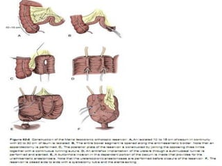 Bladder cancer surgery | PPTX