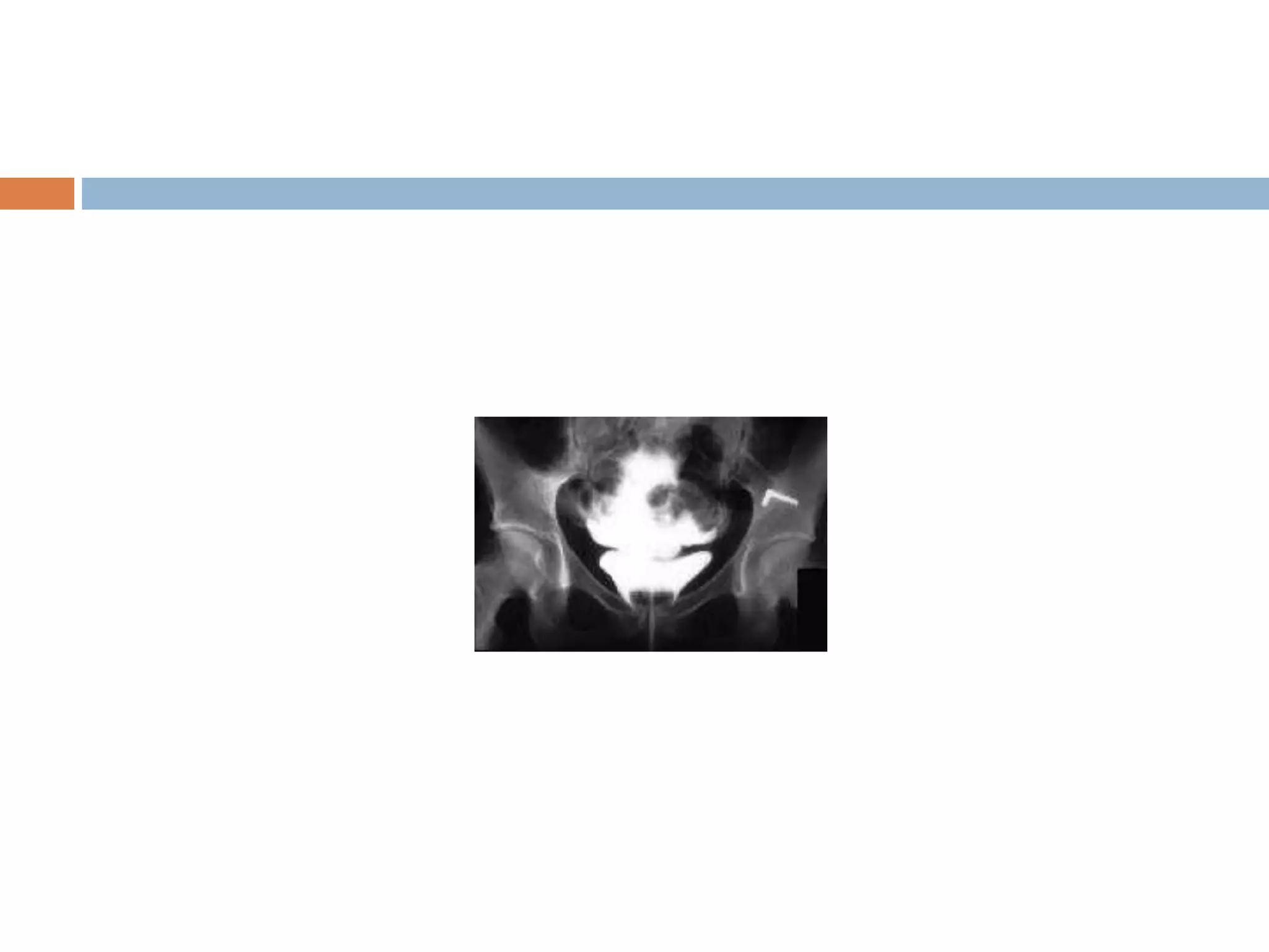 bladder trauma.ppt