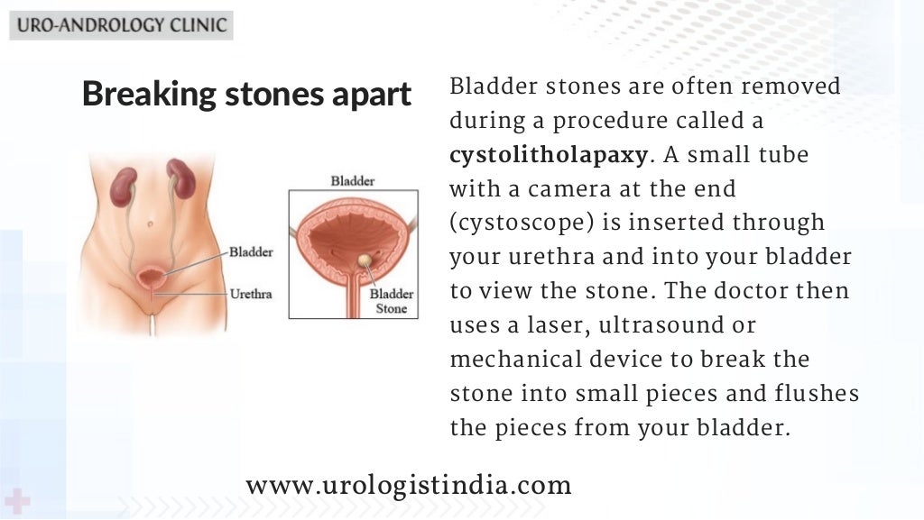 Bladder Stone Treatment in Chennai Best Urological Hospital in India