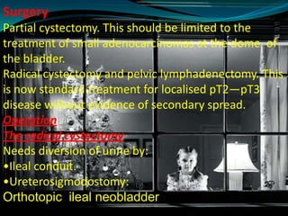 Surgery
Partial cystectomy. This should be limited to the
treatment of small adenocarcinomas at the dome of
the bladder.
Radical cystectomy and pelvic lymphadenectomy. This
is now standard treatment for localised pT2—pT3
disease without evidence of secondary spread.
Operation
The radical cystectomy
Needs diversion of urine by:
•Ileal conduit.
•Ureterosigmodostomy:
Orthotopic ileal neobladder
 