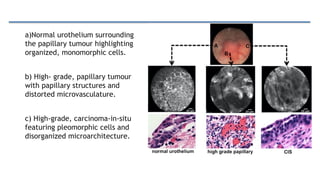 a)Normal urothelium surrounding
the papillary tumour highlighting
organized, monomorphic cells.
b) High- grade, papillary tumour
with papillary structures and
distorted microvasculature.
c) High-grade, carcinoma-in-situ
featuring pleomorphic cells and
disorganized microarchitecture.
 