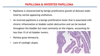 PAPILLOMA & INVERTED PAPILLOMA
• Papilloma is characterised by benign proliferative growth of delicate stalks
lined by normal appearing urothelium.
• An inverted papilloma is a benign proliferative lesion that is associated with
chronic inflammation or bladder outlet obstruction and can be located
throughout the bladder but most commonly on the trigone, accounting for
less than 1% of all bladder tumors.
• Painless gross hematuria.
• Lack of cytologic atypia.
 