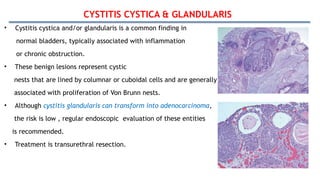 CYSTITIS CYSTICA & GLANDULARIS
• Cystitis cystica and/or glandularis is a common finding in
normal bladders, typically associated with inflammation
or chronic obstruction.
• These benign lesions represent cystic
nests that are lined by columnar or cuboidal cells and are generally
associated with proliferation of Von Brunn nests.
• Although cystitis glandularis can transform into adenocarcinoma,
the risk is low , regular endoscopic evaluation of these entities
is recommended.
• Treatment is transurethral resection.
 