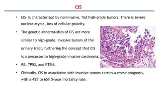 CIS
• CIS is characterized by noninvasive, flat high-grade tumors. There is severe
nuclear atypia, loss of cellular polarity.
• The genetic abnormalities of CIS are more
similar to high-grade, invasive tumors of the
urinary tract, furthering the concept that CIS
is a precursor to high-grade invasive carcinoma.
• RB, TP53, and PTEN.
• Clinically, CIS in association with invasive tumors carries a worse prognosis,
with a 45% to 65% 5-year mortality rate.
 