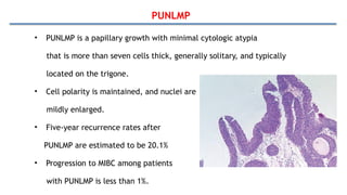 PUNLMP
• PUNLMP is a papillary growth with minimal cytologic atypia
that is more than seven cells thick, generally solitary, and typically
located on the trigone.
• Cell polarity is maintained, and nuclei are
mildly enlarged.
• Five-year recurrence rates after
PUNLMP are estimated to be 20.1%
• Progression to MIBC among patients
with PUNLMP is less than 1%.
 