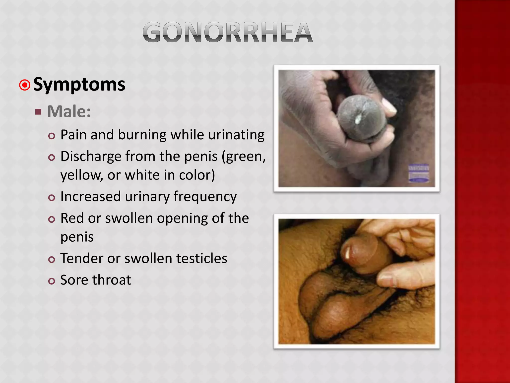 ChlamydiaThe most widespread STD in the United StatesIt is a bacterial infection that can be treated with antibioticsMore than 50% of those infected have no symptoms at allIn 2007, the rate of infection for females was over 3 times greater than the rate for males