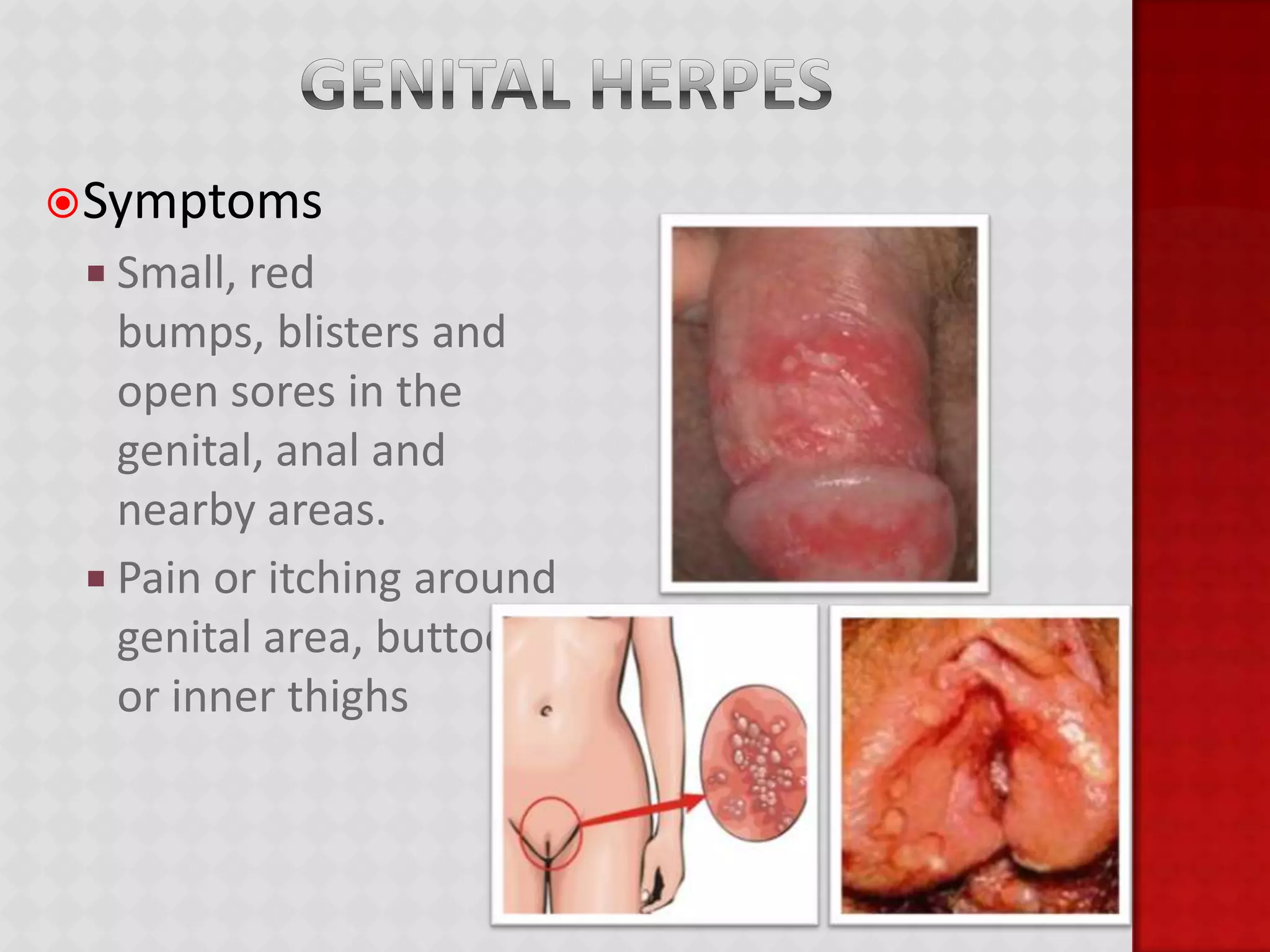 ChlamydiaSymptomsMale:Clear or cloudy discharge from the penisPainful urinationBurning and itching around the opening of the penisPain and swelling of the testicles