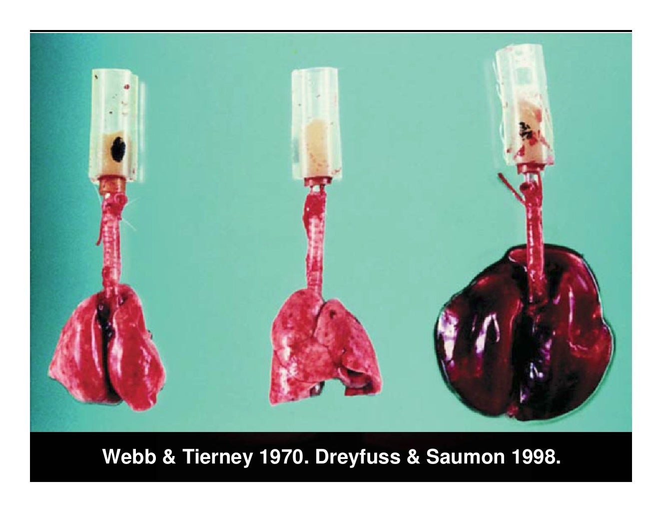 Ventilator Induced Lung Injury