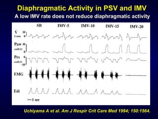 Uchiyama A et al. Am J Respir Crit Care Med 1994; 150:1564. Diaphragmatic Activity in PSV and IMV A low IMV rate does not reduce diaphragmatic activity 