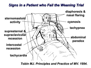 tachycardia intercostal recession supresternal & supraclavicular recession sternomastoid activity diaphoresis & nasal flaring cyanosis tachypnea abdominal paradox Tobin MJ. Principles and Practice of MV. 1994. Signs in a Patient who Fail the Weaning Trial 