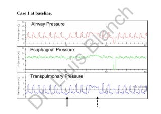 Airway Pressure
Esophageal Pressure
Transpulmonary Pressure
D
r.Lluís
Blanch
 