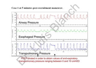 PEEP titrated in order to obtain values of end-expiratory
transpulmonary pressure ranging between 0 and 10 cmH2O
Airway Pressure
Esophageal Pressure
Transpulmonary Pressure
D
r.Lluís
Blanch
 