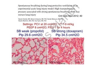 Settings: PCV at 20 cmH2O; VT 7-9 ml/kg
PEEP 8 cmH2O; FiO2 1 for 4 hours
SB weak (propofol)
Ptp 29.6 cmH2O
SB strong (doxapram)
Ptp 34.5 cmH2O
Crit Care Med 2012; 40
D
r.Lluís
Blanch
 