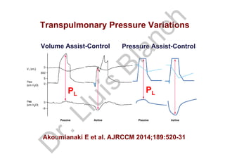 Transpulmonary Pressure Variations
Volume Assist-Control Pressure Assist-Control
PLPL
Akoumianaki E et al. AJRCCM 2014;189:520-31
D
r.Lluís
Blanch
 