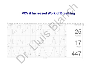 VCV & Increased Work of Breathing
D
r.Lluís
Blanch
 