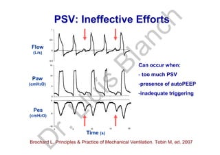 PSV: Ineffective Efforts
Paw
(cmH2O)
Pes
(cmH2O)
Flow
(L/s)
Time (s)
Brochard L. Principles & Practice of Mechanical Ventilation. Tobin M, ed. 2007
Can occur when:
- too much PSV
-presence of autoPEEP
-inadequate triggering
D
r.Lluís
Blanch
 