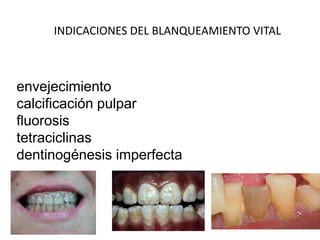 envejecimiento
calcificación pulpar
fluorosis
tetraciclinas
dentinogénesis imperfecta
INDICACIONES DEL BLANQUEAMIENTO VITAL
 