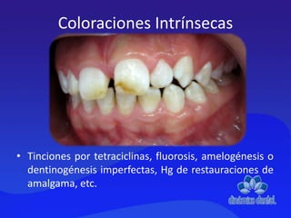 Coloraciones Intrínsecas
• Tinciones por tetraciclinas, fluorosis, amelogénesis o
dentinogénesis imperfectas, Hg de restauraciones de
amalgama, etc.
 