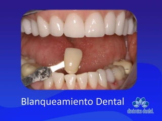 Blanqueamiento Dental
 