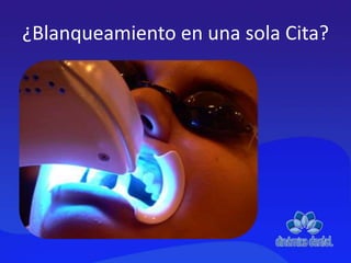 ¿Blanqueamiento en una sola Cita?
 
