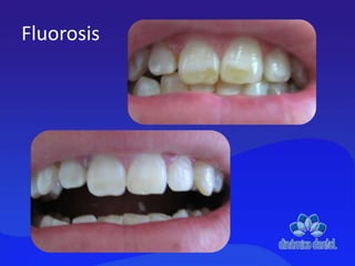 Fluorosis
 