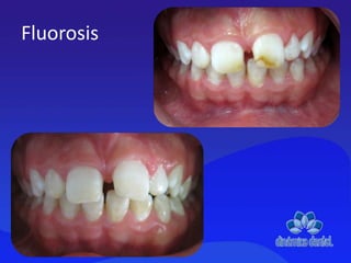 Fluorosis
 