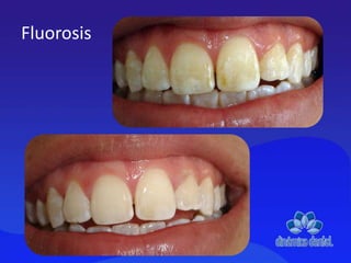 Fluorosis
 