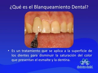 ¿Qué es el Blanqueamiento Dental?
• Es un tratamiento que se aplica a la superficie de
los dientes para disminuir la saturación del color
que presentan el esmalte y la dentina.
 